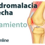 Alteración mecánica en la rodilla: causas, tratamiento y condromalacia o condropatía rotuliana.