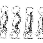 alteraciones de la columna vertebral