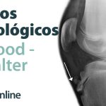 Alteraciones en la rodilla detectadas por radiografías que indican la presencia de condromalacia rotuliana.