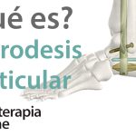 artrodesis de la columna lumbar definicion usos peligros y terapia de fisioterapia