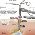 Cirugía para tratar la hernia de disco en la zona lumbar.