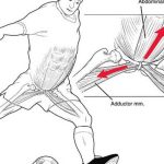 ¿Cuál es la definición de la lesión pubalgia o pubis en los jugadores de fútbol?