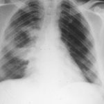 ¿Cuál es la definición de un absceso en el pulmón?