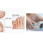 cuidados y recomendaciones para tratar los callos y la piel endurecida del pie