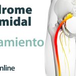 Diferenciación y tratamiento del síndrome del músculo piramidal.