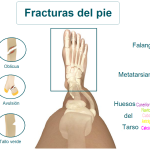 Información completa sobre las fracturas en el pie.