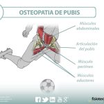 lesion en el pubis que causa molestias al deportista y puede ser tratada con osteopatia