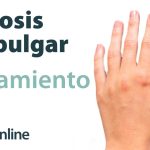 ¿Qué es la rizartrosis o artrosis del pulgar? Causas y tratamiento en fisioterapia.