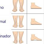 Recomendaciones y prácticas de fisioterapia para abordar el pie con arco elevado.