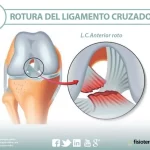 Rotura del ligamento cruzado anterior: descripción y abordaje quirúrgico del tratamiento.