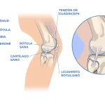 Terapia para la lesión en la rodilla derecha conocida como condromalacia rotuliana.